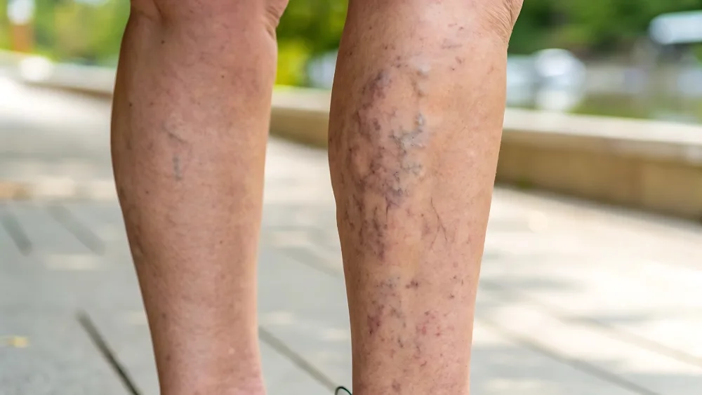 Signs and symptoms of chronic venous insufficiency on a patient's lower legs