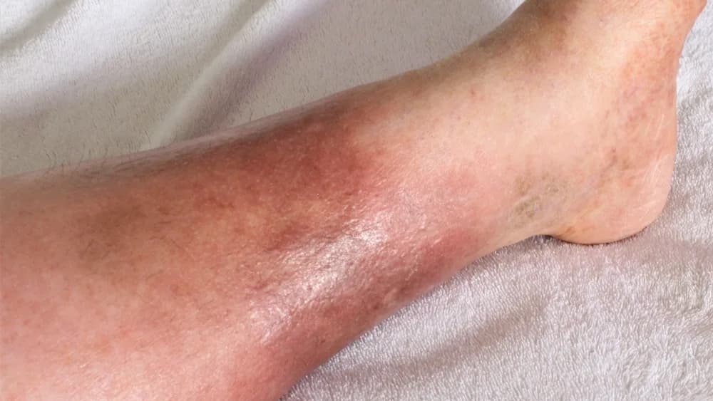Swollen lower leg and ankle being examined