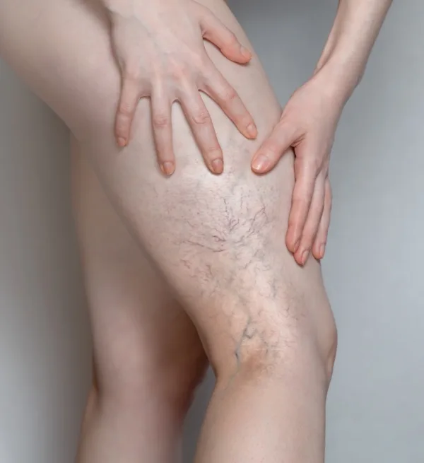 Diagram of chronic venous insufficiency showing blood pooling in leg veins