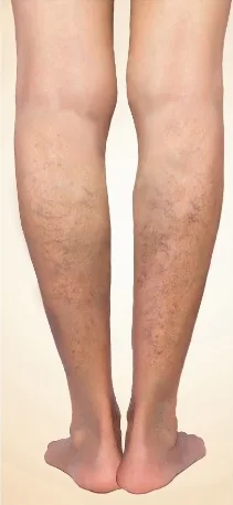Progression of venous disease: reticular varicose veins