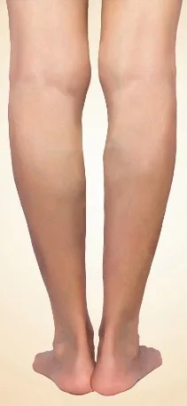 Progression of venous disease: spider veins