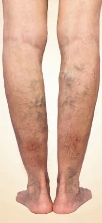 Progression of venous disease: venous insufficiency