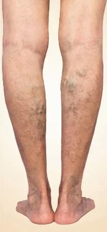 Progression of venous disease: venous nodes