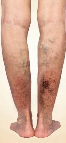 Progression of venous disease: venous ulcers