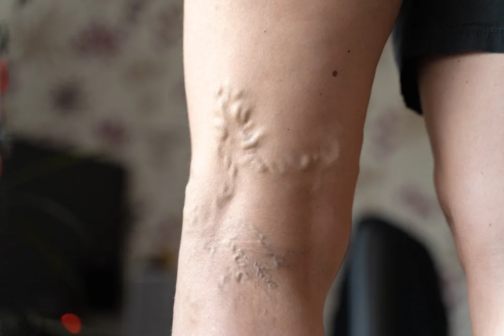 Visible varicose veins on the back of a patient's legs