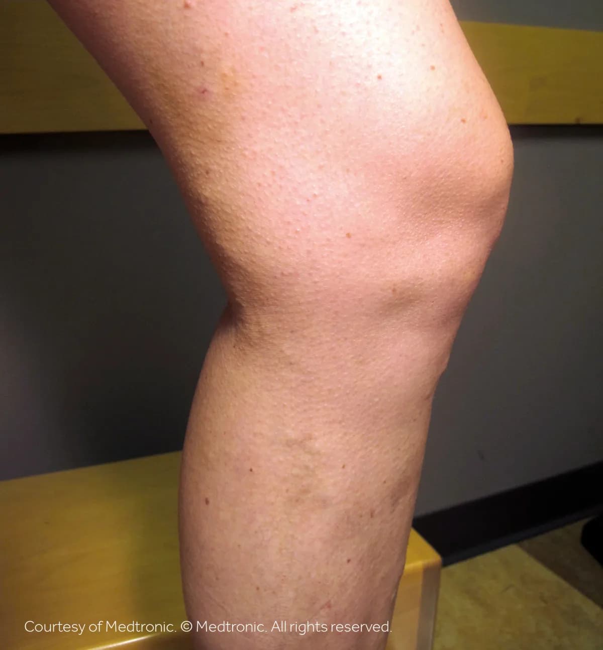 Patient 01, after vein closure procedure — bulging veins reduced.