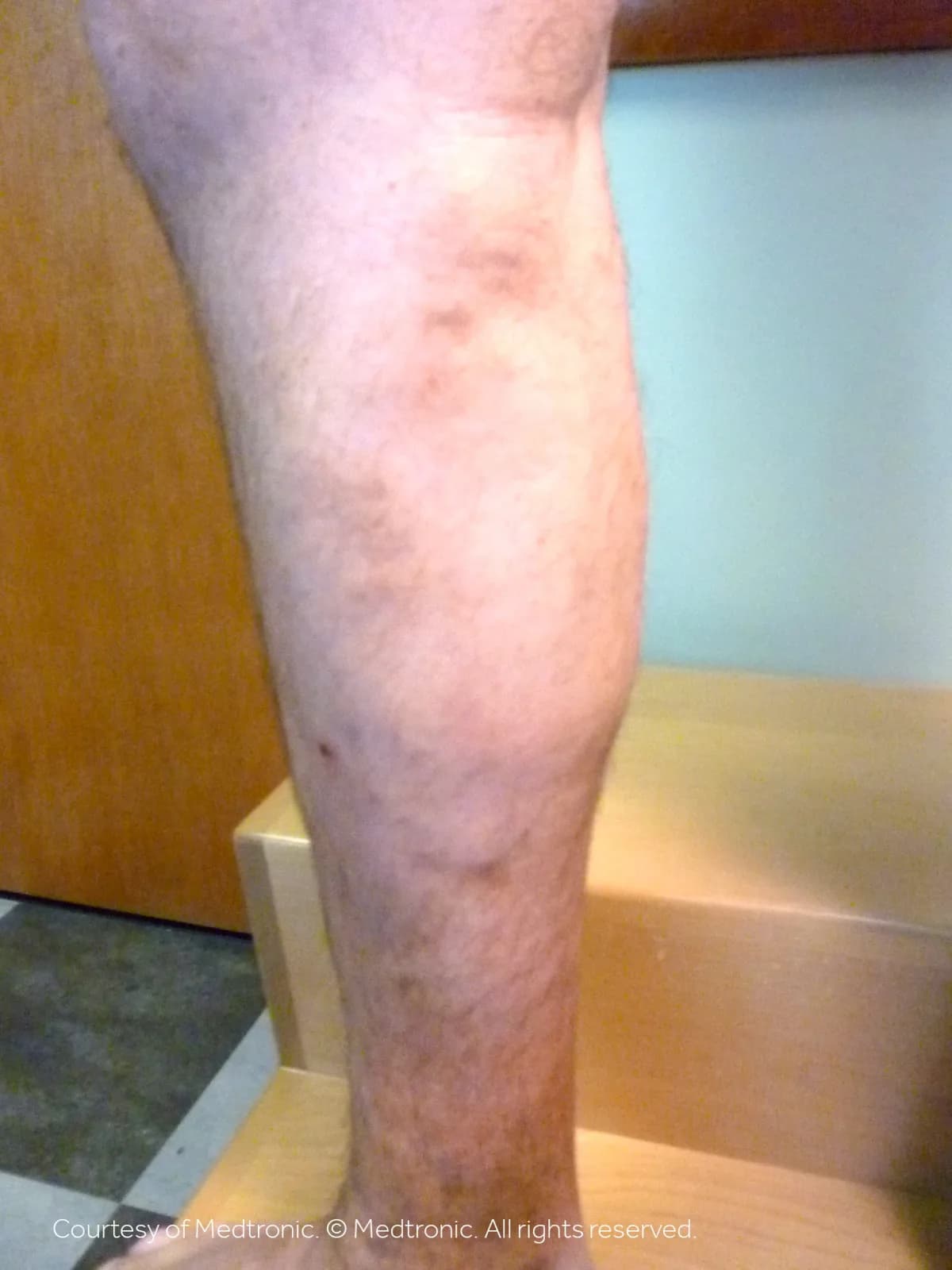 Patient 02, after vein closure procedure — bulging veins reduced.