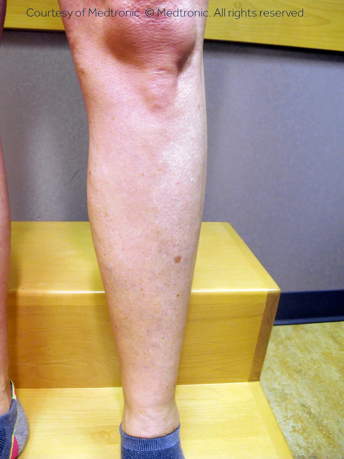 Patient 03, before vein closure procedure.