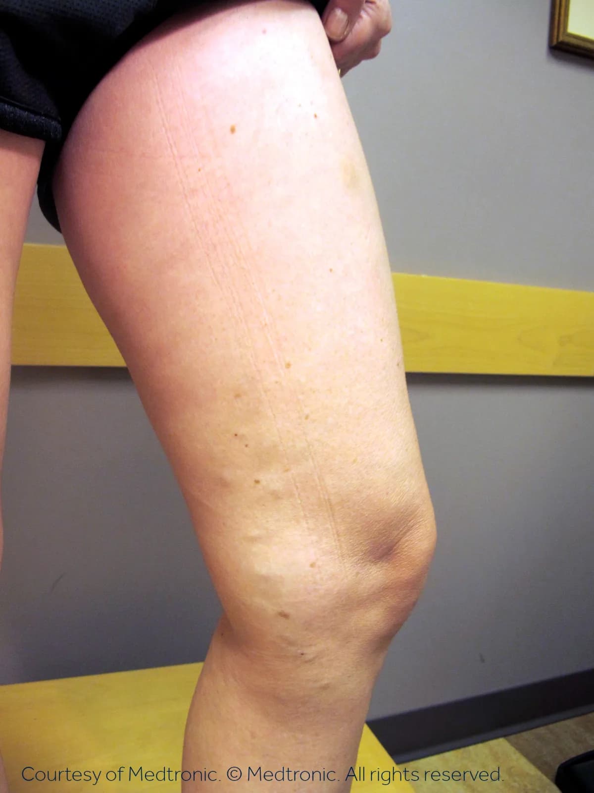 Patient 04, after vein closure procedure — bulging veins reduced.