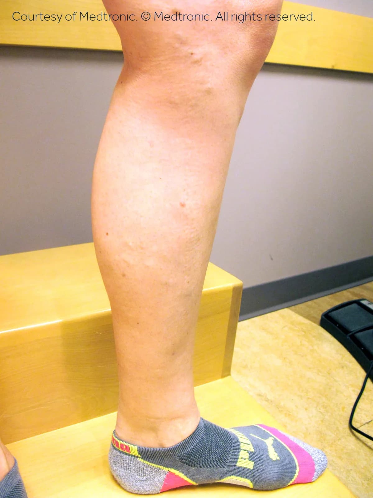Patient 05, after vein closure procedure — bulging veins reduced.