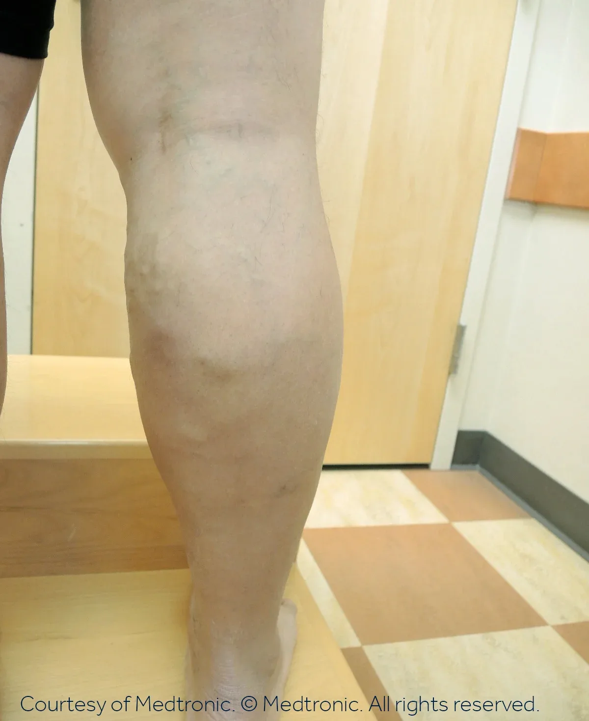 Patient 07, after vein closure procedure — bulging veins reduced.
