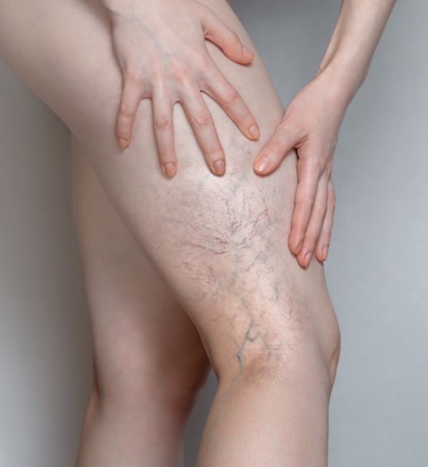 Chronic venous insufficiency illustration