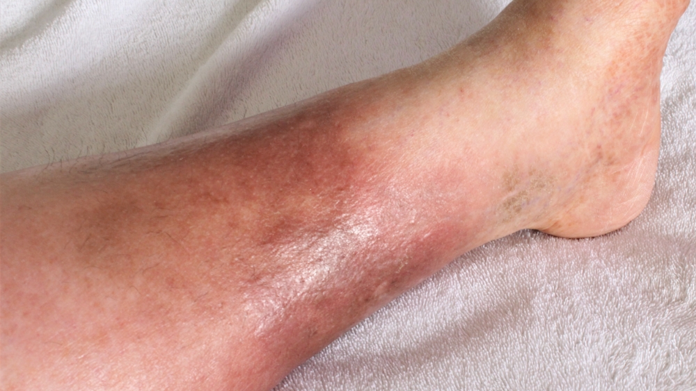 What Causes Leg Swelling? When It May Be a Vein Issue